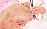 [ẢNH] Những loại bệnh dịch phổ biến do thời tiết ở Việt Nam